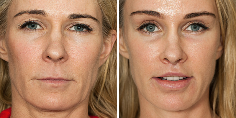 Wichtige Informationen zur Gesichts – und Stirnlifting-Operation
