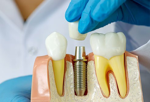 Wie läuft eine Zahnimplantat Behandlung in Alanya Antalya ab?